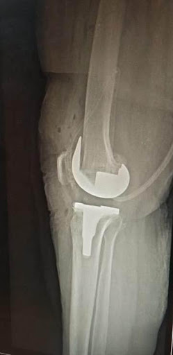 Pre and post-op x-ray of a patient-2